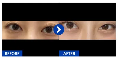 [강남언니] 눈지재, 하안검 / 1개월차 / 닉네임:난돋규