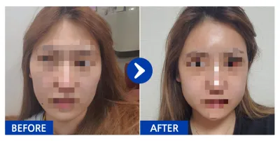 [바비톡] 광대, 사각턱 / 3주차 / 닉네임:223345