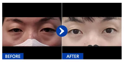 [바비톡] 눈지재 / 1개월차 / 닉네임:효듀리