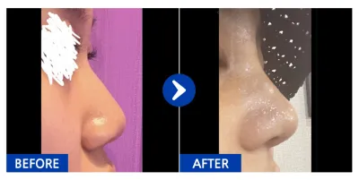 [강남언니] 코 / 1개월차 / 닉네임:kirakira.s