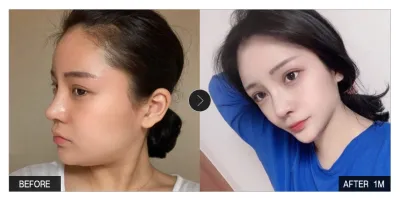 [강남언니 후기] 얼굴지방흡입 한 달차 / 닉네임 : 솜사탕모구