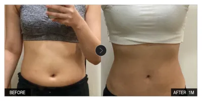 [강남언니 후기] 지방흡입 1개월차 / 닉네임 : 솜사탕모구