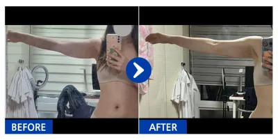 [바비톡] 지방흡입 / 1개월차 / 닉네임:미튄토끼