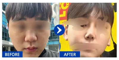 [강남언니] 코성형 / 2개월차/ 닉네임:코가고민입니다