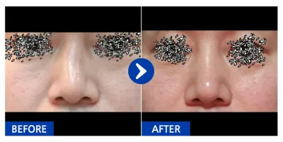 [바비톡] 코성형 / 1개월차/ 닉네임:슈퍼츄