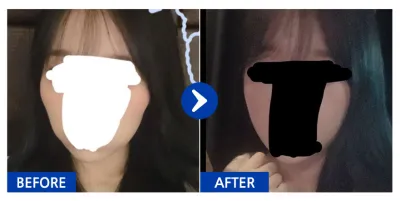 [강남언니] 광대 / 1개월차/ 닉네임:짝눈이잘못했네;