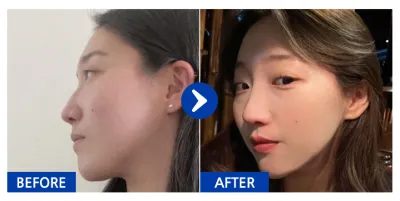 [바비톡] 코성형 / 1년차/ 닉네임:atmospe