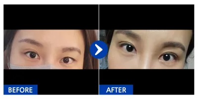 [강남언니] 자연유착(쌍꺼풀) / 2주차/ 닉네임:달벙잉