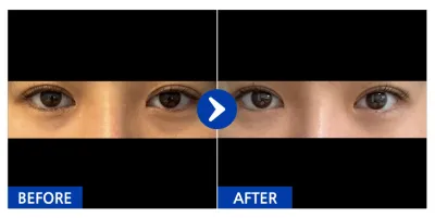 [강남언니] 눈밑지방재배치 / 1개월차/ 닉네임: OooO와