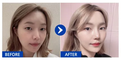 [강남언니] 코재수술 / 1개월차/ 닉네임: ohnee5