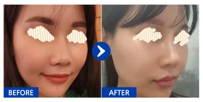 [바비톡] 코재수술 / 1개월차/ 닉네임: wane