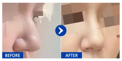 [강남언니] 코재수술 / 1개월차/ 닉네임: jjjejjj