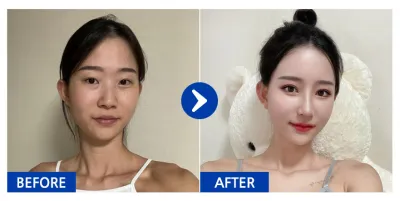 [강남언니] 눈재수술, 눈밑지방재배치, 코, 윤곽2종(광대, 사각턱), 가슴(모티바), 지방이식(이마, 앞볼) / 1개월차 /닉네임: 듀두듀듀