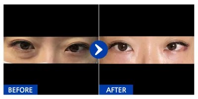 [바비톡] 눈밑지방재배치 / 1개월차/ 닉네임: yoouii