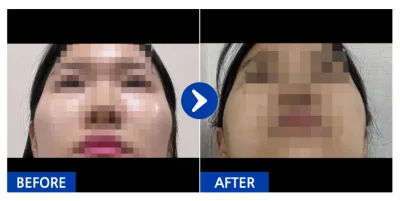 [강남언니] 안면윤곽(광대) / 3주차/ 닉네임: beami