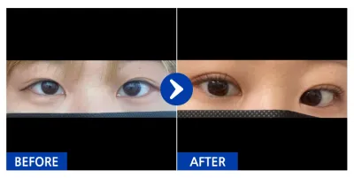 [바비톡] 자연유착(쌍꺼풀) / 1개월차/ 닉네임: 당산미녀