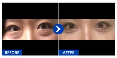 [강남언니] 눈밑재배치 / 1개월차/ 닉네임: 쓰잉