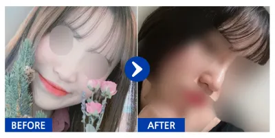 [강남언니] 코성형 1개월차 / 닉네임 : v1nnn