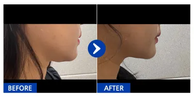 [강남언니] 얼굴지방흡입 1개월차 / 닉네임 : mj_park