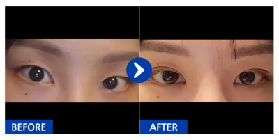 [강남언니] 자연유착(쌍꺼풀) 1개월차 / 닉네임 : 킬러연습생