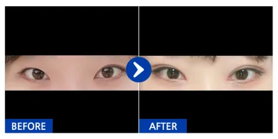 [강남언니] 자연유착(쌍꺼풀), 앞트임, 눈매교정 1개월차 / 닉네임 : 포하항푸하항