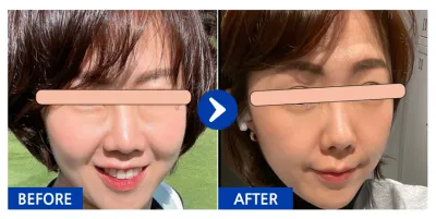 [강남언니] 눈밑지방재배치 1개월차 / 닉네임 : 체리콩7