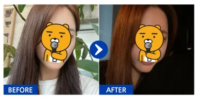 [강남언니] 광대 1개월차 / 닉네임 : 유후후후후ㅜ