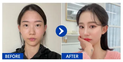 [바비톡] 눈재수술, 눈밑지방재배치, 코, 윤곽2종(광대, 사각턱), 가슴(모티바), 지방이식(이마, 앞볼) / 3개월차 /닉네임: 듀듀듀쥬쥬