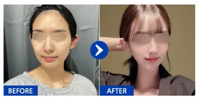 [강남언니] 윤곽2종(사각턱, 광대) 1개월차 / 닉네임 : 투율이