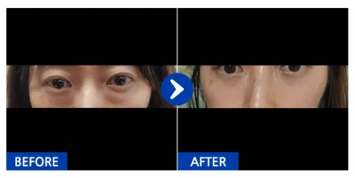 [강남언니] 눈밑지방재배치, 앞볼지방이식 1개월차 / 닉네임 : 라라라랑인