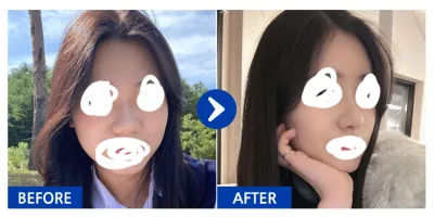 [강남언니]코성형, 지방이식 1개월차 / 닉네임 : sunbini