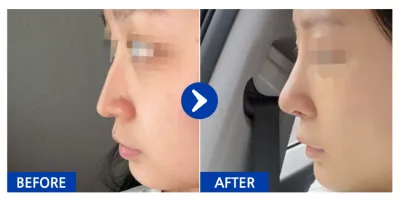 [강남언니] 코성형 1주차 / 닉네임 : 쀵삥