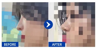 [강남언니] 코성형 1개월차_aaaa1212