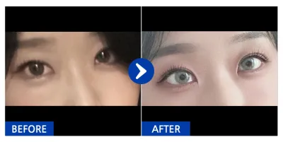 [강남언니] 눈밑지방재배치 / 1개월차 / 닉네임 : hyupp