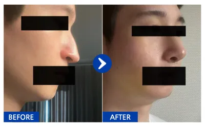 [바비톡] 코성형 1개월차/ 닉네임:여우9Kcqw