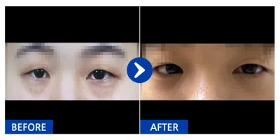 [강남언니] 눈밑지방재배치 / 1개월차 / 닉네임 : yykkyyk