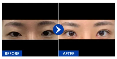 [강남언니]  쌍커풀,앞트임,눈매교정 / 1개월차 / 닉네임 : 으비라아레벱