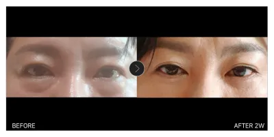 [강남언니 후기] 하안검+실리프팅 2주차 / 닉네임 : 가니시니