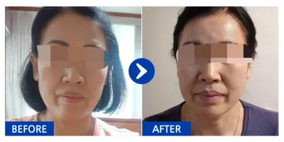 [바비톡] 실리프팅 1개월차 / 닉네임:냥이b6sKx