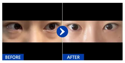 [강남언니] 눈밑지방재배치 / 1개월차 / 닉네임 : castle030