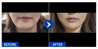 [강남언니] 실리프팅 1개월차 / 닉네임:이미선.