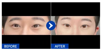 [강남언니] 눈밑지방재배치 / 1개월차 / 닉네임 : 쟝쟝59