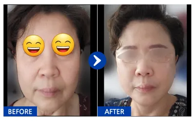 [강남언니] 실리프팅 1개월차 / 닉네임:엽기토깽이