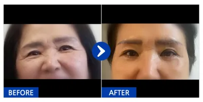 [강남언니] 눈썹거상술,하안검 / 1개월차 / 닉네임 : 잠실자네