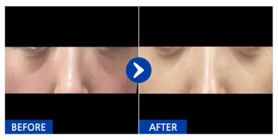 [강남언니] 눈밑지방재배치 / 1개월차 / 닉네임 : 라면김밥떡볶이