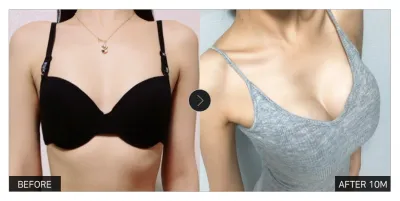 [강남언니 후기] 가슴성형 10개월차 / 닉네임 : 그마아아안