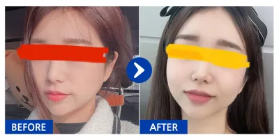 [바비톡] 풀페이스지방이식 / 1개월차 / 닉네임 : 주유비