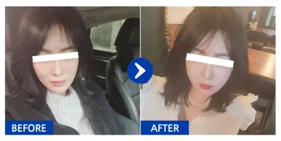 [바비톡] 풀페이스지방이식, 실리프팅 / 2주차 / 닉네임 : 갱쥐zXzo