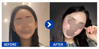 [강남언니] 풀페이스지방이식 / 1개월차 / 닉네임 : 예뻐지쟈아아