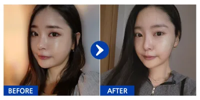 [강남언니] 얼굴지방흡입 / 1개월차 / 닉네임 : 감자모찡